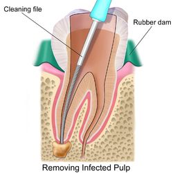 Root Canal Treatment Pain