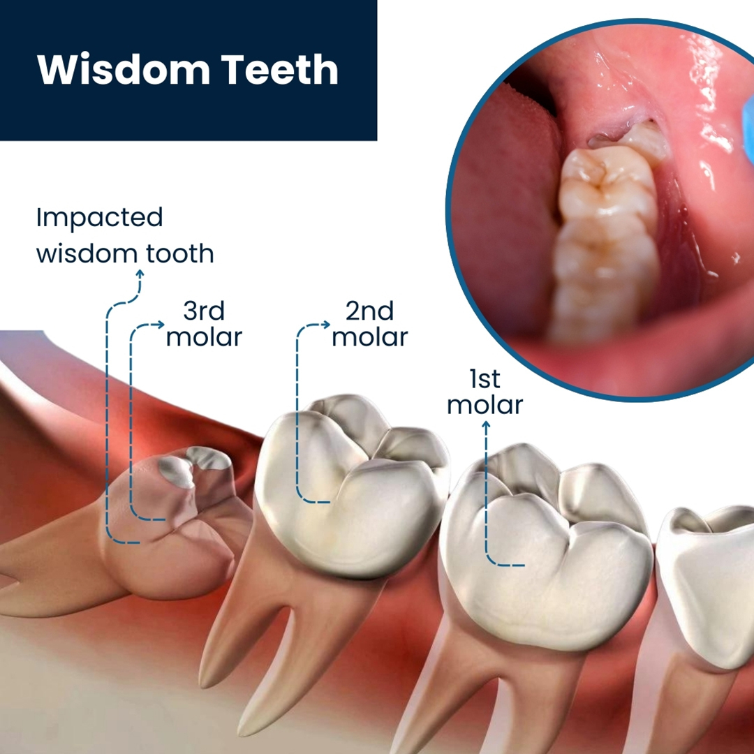 Wisdom Tooth Removal Painless Procedure