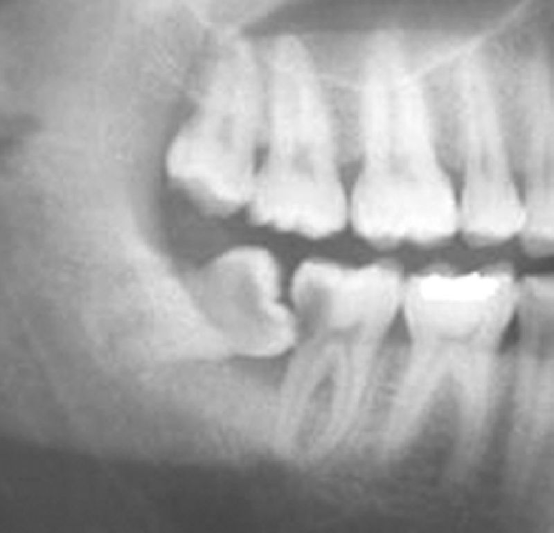 Advanced Painless Removal